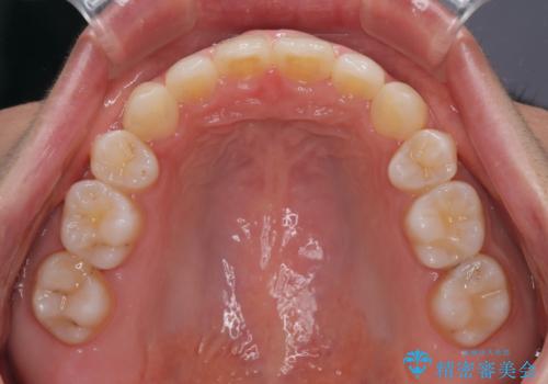 口ゴボが気になる　上下4本の抜歯矯正の治療後