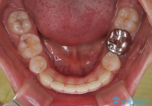 口ゴボが気になる　上下4本の抜歯矯正の治療後