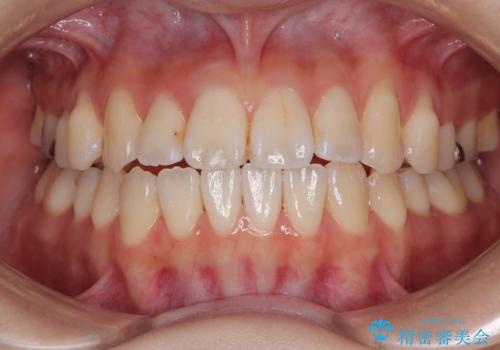 舌の突出癖が原因 インビザライン矯正による開咬改善の治療中