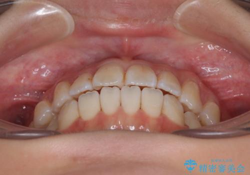 舌の突出癖が原因 インビザライン矯正による開咬改善の治療中