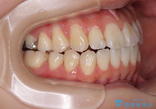 舌の突出癖が原因　インビザライン矯正による開咬改善の治療中