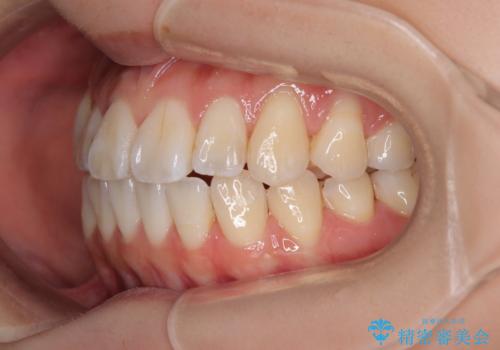 舌の突出癖が原因 インビザライン矯正による開咬改善の治療中