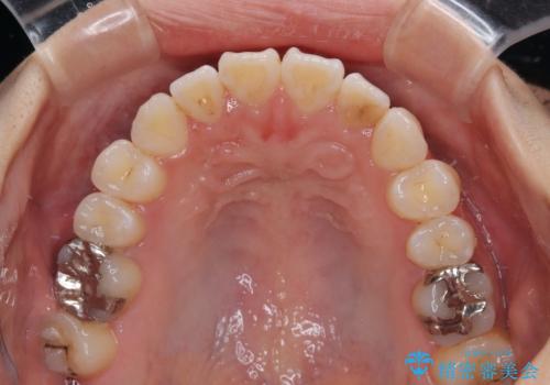 舌の突出癖が原因　インビザライン矯正による開咬改善の治療中