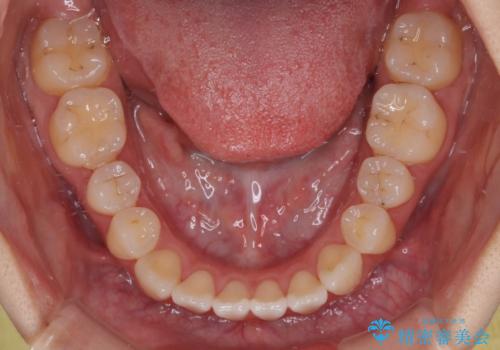 舌の突出癖が原因　インビザライン矯正による開咬改善の治療中