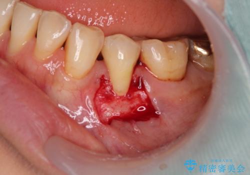 露出した歯根が気になる　歯肉移植による根面被覆術の治療中