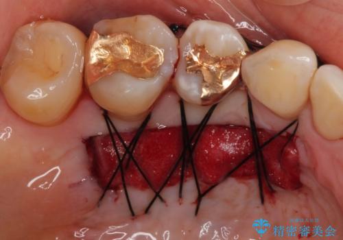 露出した歯根が気になる 歯肉移植による根面被覆術の治療中