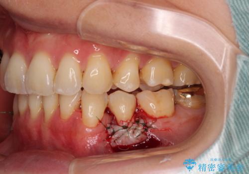 露出した歯根が気になる 歯肉移植による根面被覆術の治療中