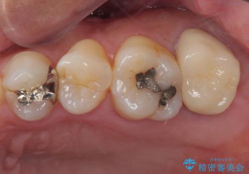 腫れて痛む奥歯　抜歯を覚悟した歯のむし歯治療の症例 治療後
