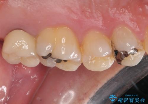腫れて痛む奥歯 抜歯を覚悟した歯のむし歯治療の治療後