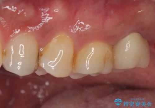 腫れて痛む奥歯　抜歯を覚悟した歯のむし歯治療の治療後
