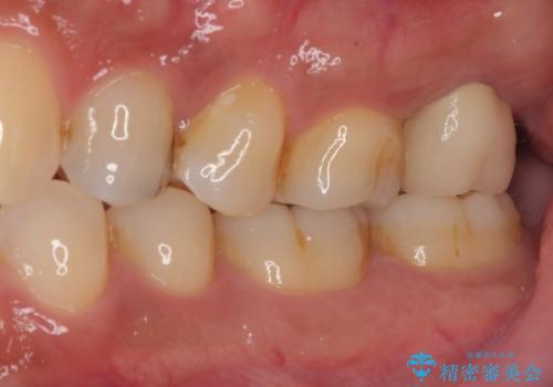腫れて痛む奥歯 抜歯を覚悟した歯のむし歯治療の治療後