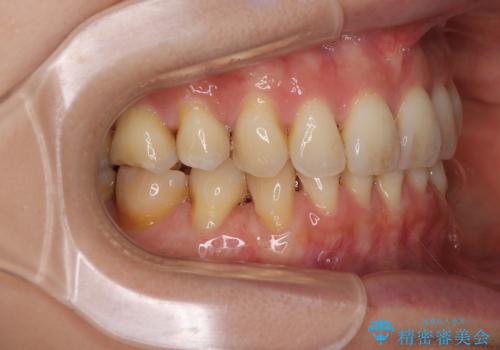 露出した歯根が気になる 歯肉移植による根面被覆術の治療後