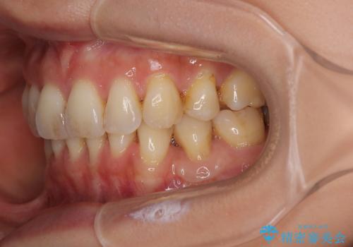 露出した歯根が気になる 歯肉移植による根面被覆術の治療後