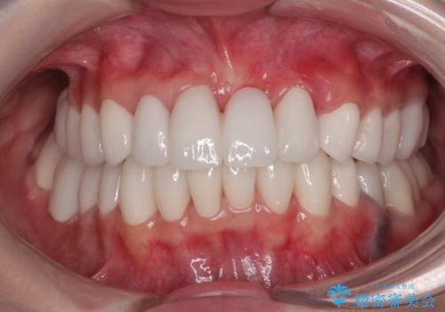 かかりつけ医の治療方針に疑問 歯周病治療と矯正治療を合わせた総合歯科治療の症例 治療後