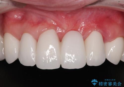 かかりつけ医の治療方針に疑問　歯周病治療と矯正治療を合わせた総合歯科治療の治療後