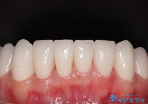 かかりつけ医の治療方針に疑問　歯周病治療と矯正治療を合わせた総合歯科治療の治療後