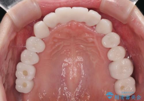 かかりつけ医の治療方針に疑問 歯周病治療と矯正治療を合わせた総合歯科治療の治療後