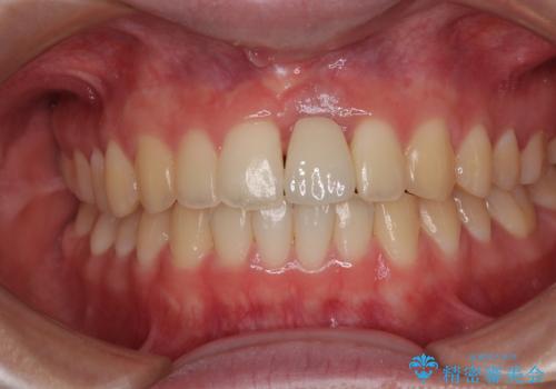 歯根吸収した前歯 短期間でのインプラント治療の治療後