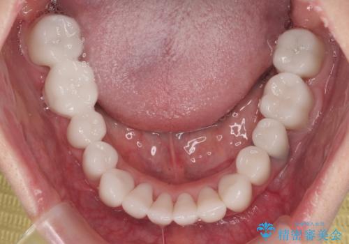 かかりつけ医の治療方針に疑問 歯周病治療と矯正治療を合わせた総合歯科治療の治療後