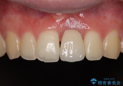 歯根吸収した前歯 短期間でのインプラント治療の治療後