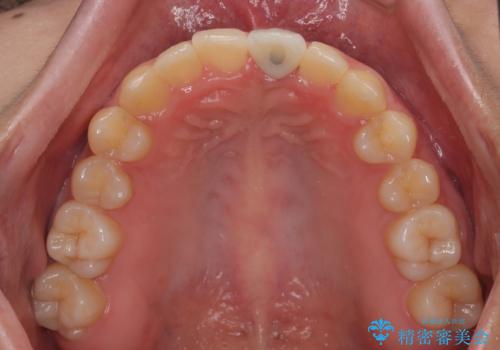 歯根吸収した前歯 短期間でのインプラント治療の治療後