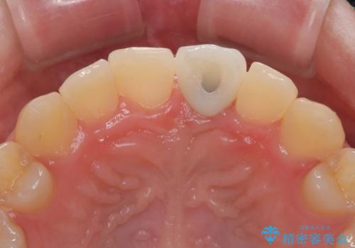 歯根吸収した前歯 短期間でのインプラント治療の治療後