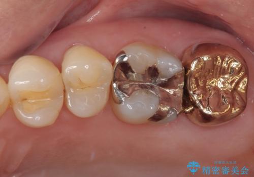 放置した奥歯のむし歯 ゴールドクラウン補綴治療の症例 治療後