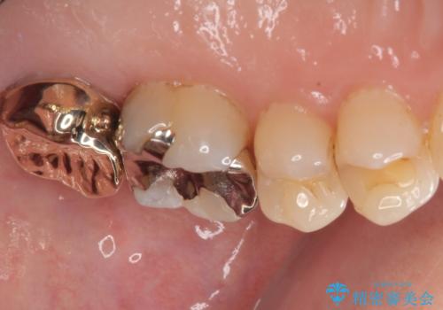 放置した奥歯のむし歯 ゴールドクラウン補綴治療の治療後
