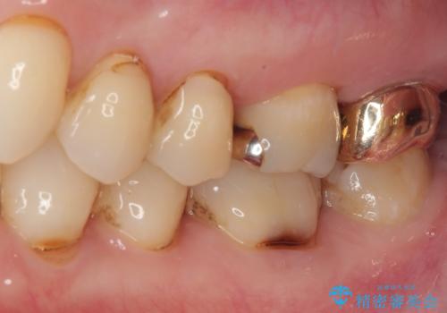 放置した奥歯のむし歯　ゴールドクラウン補綴治療の治療後