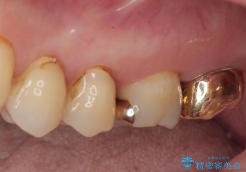 放置した奥歯のむし歯　ゴールドクラウン補綴治療の治療後