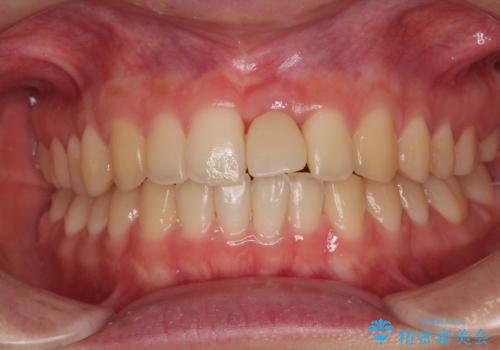 歯根吸収した前歯　短期間でのインプラント治療の治療中