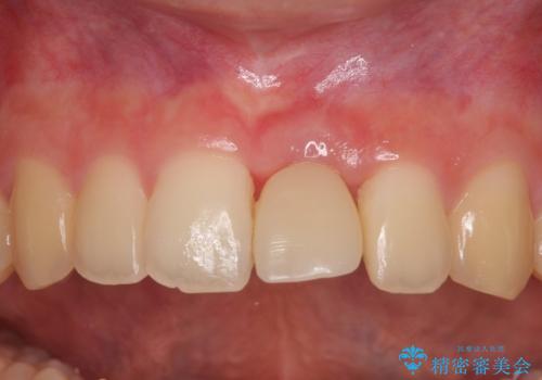 歯根吸収した前歯　短期間でのインプラント治療の治療中