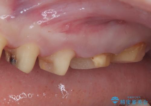 かかりつけ医の治療方針に疑問　歯周病治療と矯正治療を合わせた総合歯科治療の治療前