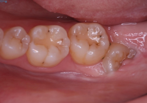 親知らず抜歯の治療前