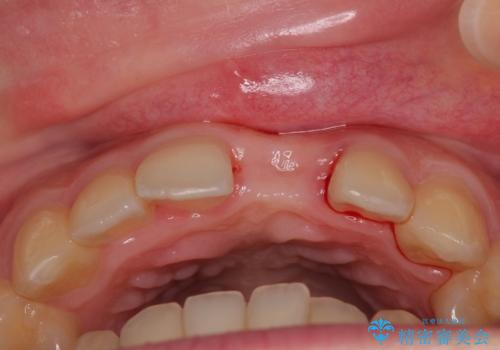 歯根吸収した前歯 短期間でのインプラント治療の治療中
