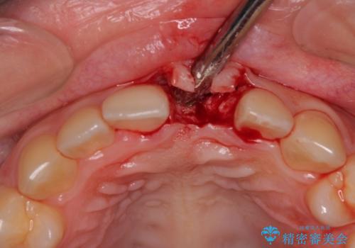 歯根吸収した前歯 短期間でのインプラント治療の治療後