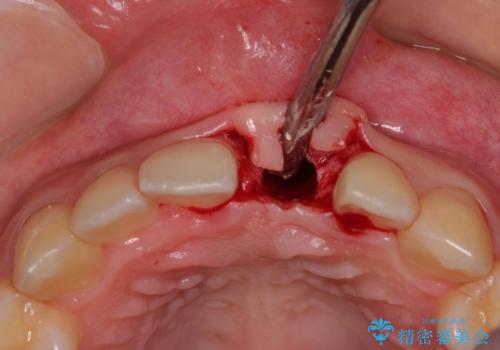 歯根吸収した前歯　短期間でのインプラント治療の治療前