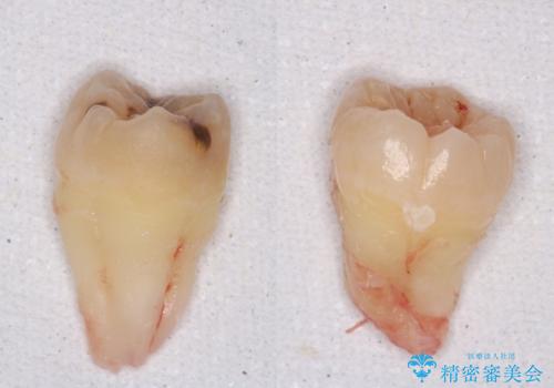 親知らず抜歯の治療中