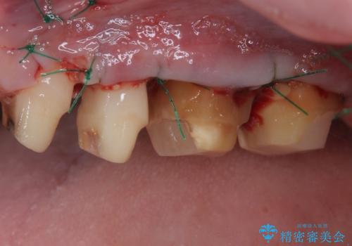 かかりつけ医の治療方針に疑問　歯周病治療と矯正治療を合わせた総合歯科治療の治療後