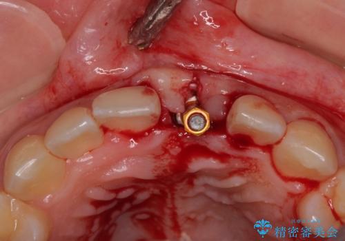 歯根吸収した前歯　短期間でのインプラント治療の治療中