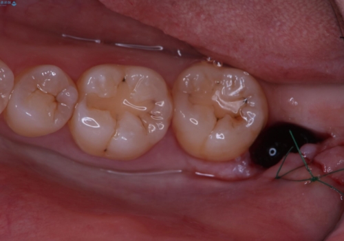 親知らず抜歯の治療後