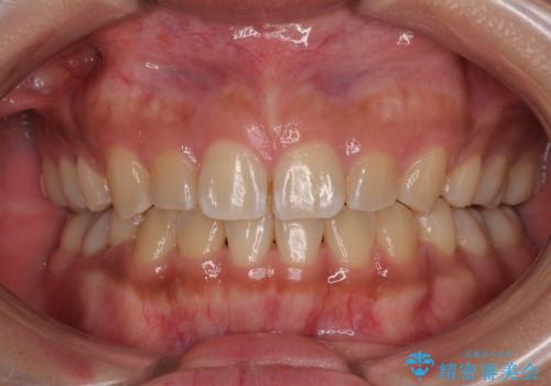 デコボコと捻れて前に飛び出した歯列 抜歯矯正でスッキリした口元にの症例 治療後