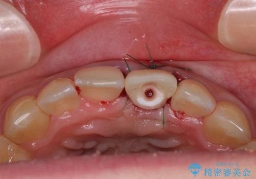 歯根吸収した前歯 短期間でのインプラント治療の治療中
