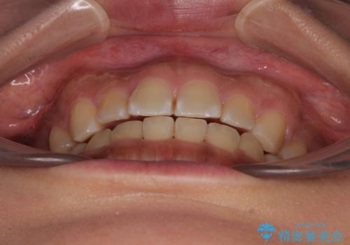 デコボコと捻れて前に飛び出した歯列 抜歯矯正でスッキリした口元にの治療後