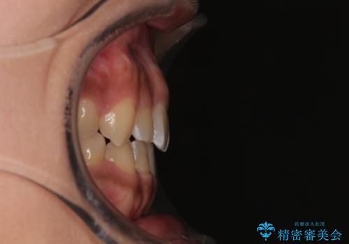 デコボコと捻れて前に飛び出した歯列 抜歯矯正でスッキリした口元にの治療後