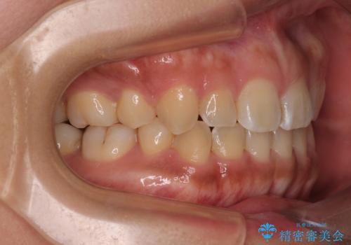 デコボコと捻れて前に飛び出した歯列 抜歯矯正でスッキリした口元にの治療後