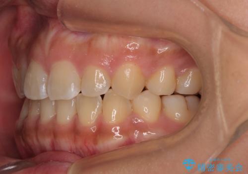 デコボコと捻れて前に飛び出した歯列 抜歯矯正でスッキリした口元にの治療後