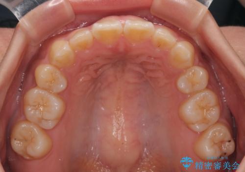 デコボコと捻れて前に飛び出した歯列　抜歯矯正でスッキリした口元にの治療後