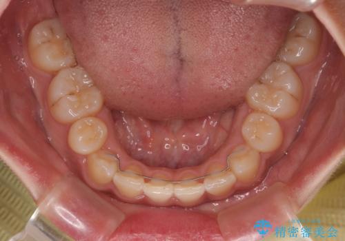 デコボコと捻れて前に飛び出した歯列 抜歯矯正でスッキリした口元にの治療後