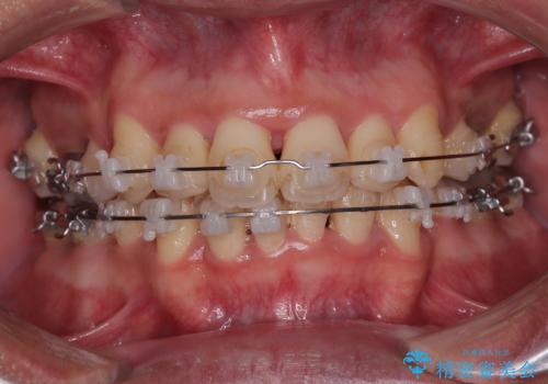 矯正治療途中で転院 遠方への転勤で通院困難な方の矯正治療の症例 治療前